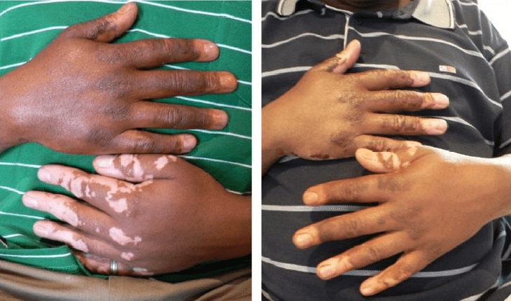 Healed results Vitiligo 2