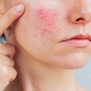 Sensitive / Irritation-Prone Skin