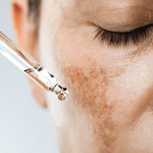 Pigmentation Prone Skin